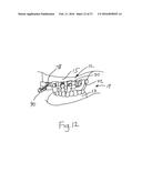 BONE FOUNDATION GUIDE SYSTEM AND METHOD diagram and image