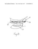 BONE FOUNDATION GUIDE SYSTEM AND METHOD diagram and image