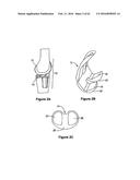 SYSTEMS AND METHODS FOR PROVIDING A STEM ON A TIBIAL COMPONENT diagram and image