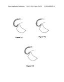 SYSTEMS AND METHODS FOR PROVIDING A STEM ON A TIBIAL COMPONENT diagram and image