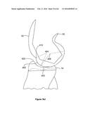 SYSTEMS AND METHODS FOR PROVIDING A STEM ON A TIBIAL COMPONENT diagram and image