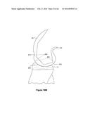 SYSTEMS AND METHODS FOR PROVIDING A STEM ON A TIBIAL COMPONENT diagram and image