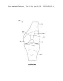 SYSTEMS AND METHODS FOR PROVIDING A STEM ON A TIBIAL COMPONENT diagram and image