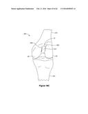 SYSTEMS AND METHODS FOR PROVIDING A STEM ON A TIBIAL COMPONENT diagram and image