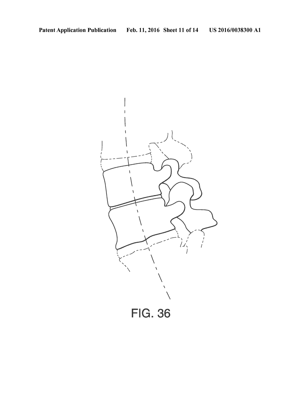 SPINAL INTERVERTEBRAL IMPLANT - diagram, schematic, and image 12