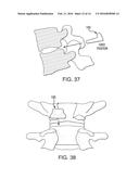 SPINAL INTERVERTEBRAL IMPLANT diagram and image