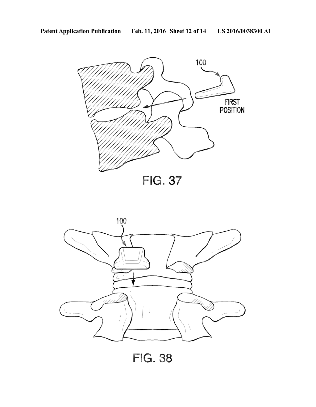 SPINAL INTERVERTEBRAL IMPLANT - diagram, schematic, and image 13