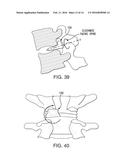 SPINAL INTERVERTEBRAL IMPLANT diagram and image