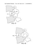 SPINAL INTERVERTEBRAL IMPLANT diagram and image