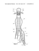 ENDOVASCULAR GRAFT HAVING A CANNULATION POCKET diagram and image