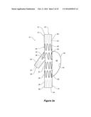 ENDOVASCULAR GRAFT HAVING A CANNULATION POCKET diagram and image