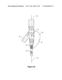 ENDOVASCULAR GRAFT HAVING A CANNULATION POCKET diagram and image