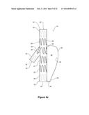 ENDOVASCULAR GRAFT HAVING A CANNULATION POCKET diagram and image