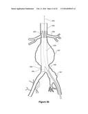 ENDOVASCULAR GRAFT HAVING A CANNULATION POCKET diagram and image