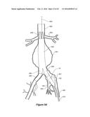 ENDOVASCULAR GRAFT HAVING A CANNULATION POCKET diagram and image