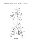 ENDOVASCULAR GRAFT HAVING A CANNULATION POCKET diagram and image