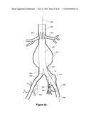 ENDOVASCULAR GRAFT HAVING A CANNULATION POCKET diagram and image