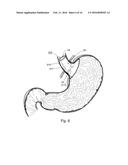 BARIATRIC DEVICE AND METHOD diagram and image