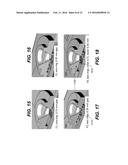 LATERAL-FLOW ASSAY DEVICE HAVING FLOW CONSTRICTIONS diagram and image