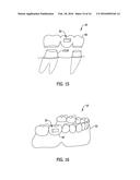 DENTAL APPLIANCE FOR USE IN SUPPORTING SENSING DEVICES WITHIN AN ORAL     CAVITY diagram and image