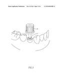 DENTAL IMPLANT PACKAGE diagram and image