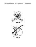 MALE URETHRAL PROSTHESIS WITH TENSIONING MEMBER diagram and image