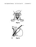 MALE URETHRAL PROSTHESIS WITH TENSIONING MEMBER diagram and image