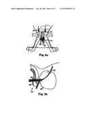 MALE URETHRAL PROSTHESIS WITH TENSIONING MEMBER diagram and image