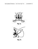 MALE URETHRAL PROSTHESIS WITH TENSIONING MEMBER diagram and image