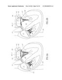 CARDIAC VALVE COMMISSURE BRACE diagram and image