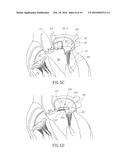 CARDIAC VALVE COMMISSURE BRACE diagram and image