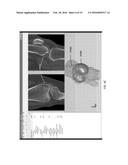 Kinematic and Parameterized Modeling for Patient-Adapted Implants, Tools,     and Surgical Procedures diagram and image