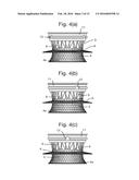 IMPLANT CONTAINING RODS diagram and image