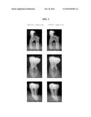 INFILTRATION SOLUTION FOR TREATING AN ENAMEL LESION diagram and image