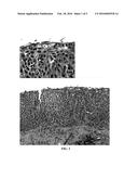 VISCOUS BUDESONIDE FOR THE TREATMENT OF INFLAMMATORY DISEASES OF THE     GASTROINTESTINAL TRACT diagram and image