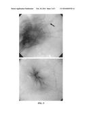 VISCOUS BUDESONIDE FOR THE TREATMENT OF INFLAMMATORY DISEASES OF THE     GASTROINTESTINAL TRACT diagram and image