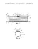 Implanted Extracardiac Device for Circulatory Assistance diagram and image