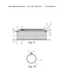 Implanted Extracardiac Device for Circulatory Assistance diagram and image