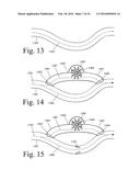 Implanted Extracardiac Device for Circulatory Assistance diagram and image