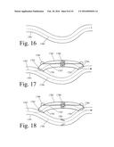 Implanted Extracardiac Device for Circulatory Assistance diagram and image