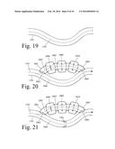 Implanted Extracardiac Device for Circulatory Assistance diagram and image