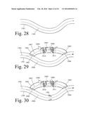 Implanted Extracardiac Device for Circulatory Assistance diagram and image