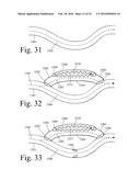 Implanted Extracardiac Device for Circulatory Assistance diagram and image