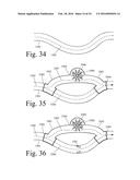 Implanted Extracardiac Device for Circulatory Assistance diagram and image