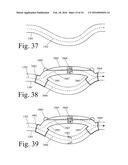 Implanted Extracardiac Device for Circulatory Assistance diagram and image