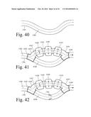 Implanted Extracardiac Device for Circulatory Assistance diagram and image