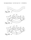 Implanted Extracardiac Device for Circulatory Assistance diagram and image