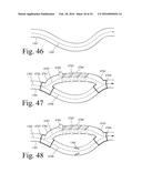 Implanted Extracardiac Device for Circulatory Assistance diagram and image