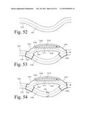 Implanted Extracardiac Device for Circulatory Assistance diagram and image