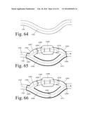 Implanted Extracardiac Device for Circulatory Assistance diagram and image